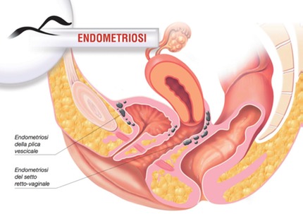 endometriosi