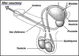 vasectomy01